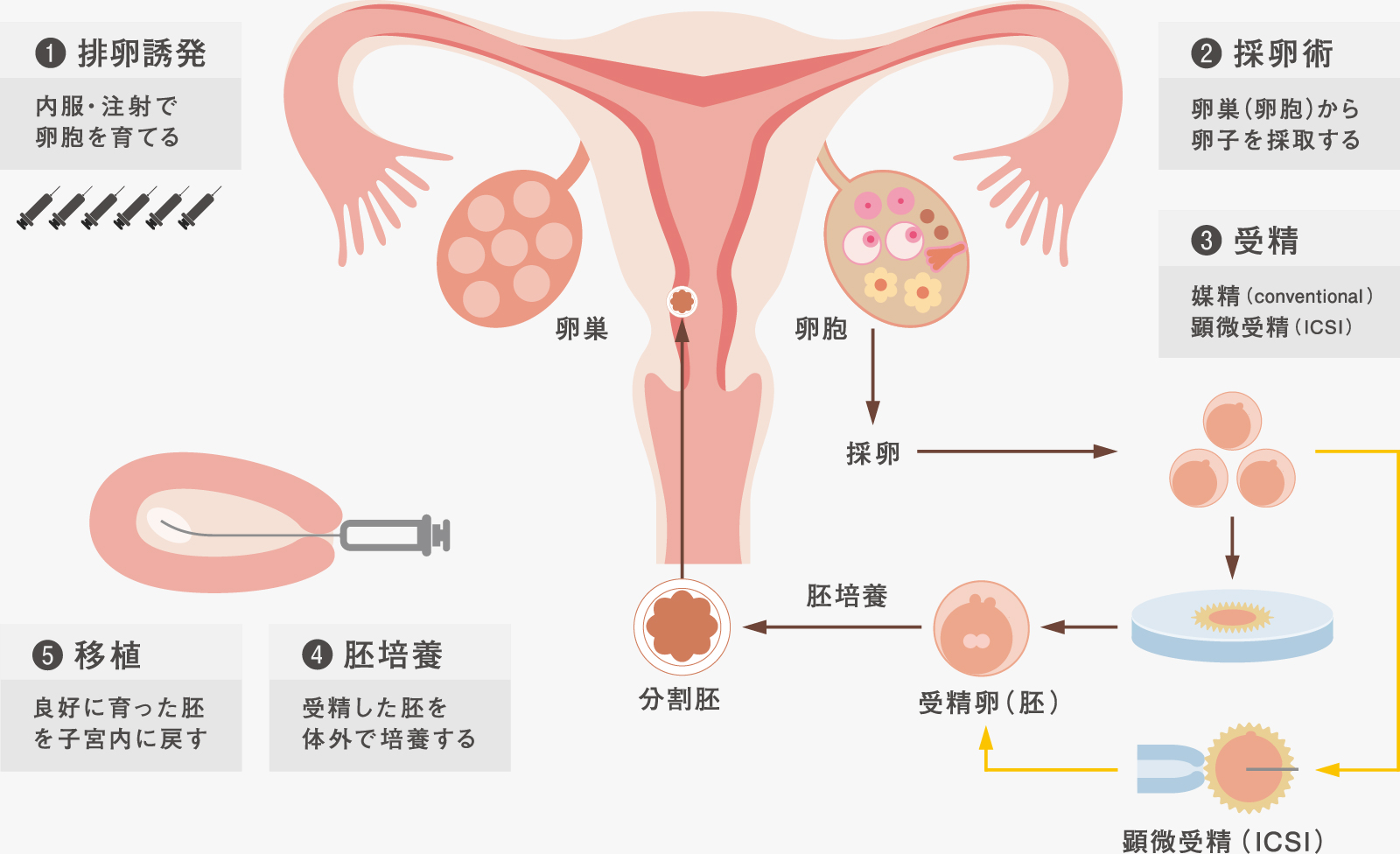 1採卵誘発, 2採卵術, 3受精, 4胚培養, 5移植