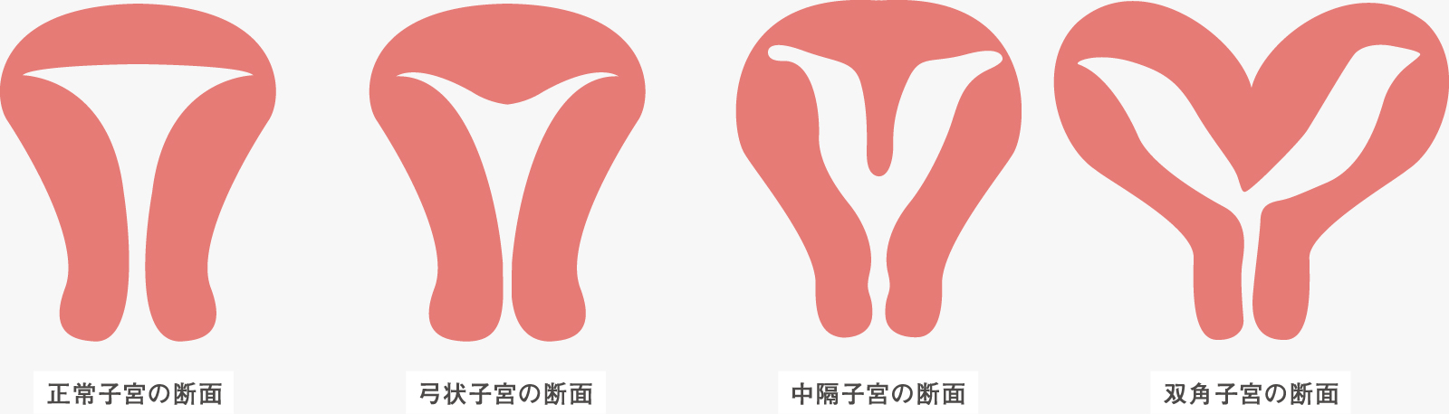 正常子宮の断面, 弓状子宮の断面, 中隔子宮の断面, 双角子宮の断面